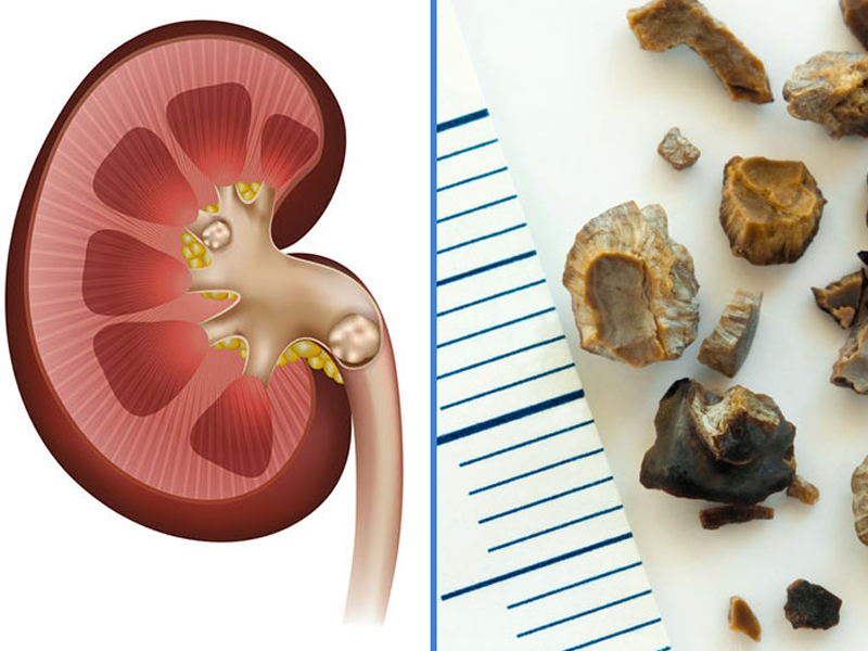 Böbrek taşı ihmale gelmiyor!